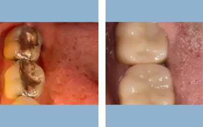 Before and After